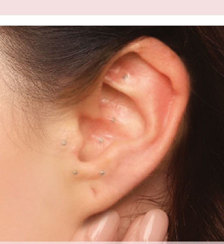 Auricular Therapy